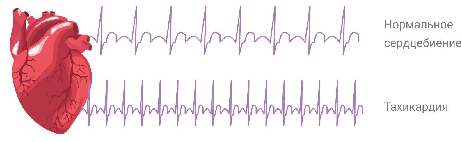 Кардиограмма тахикардии (учащенное сердцебиение) при железодефицитной анемии